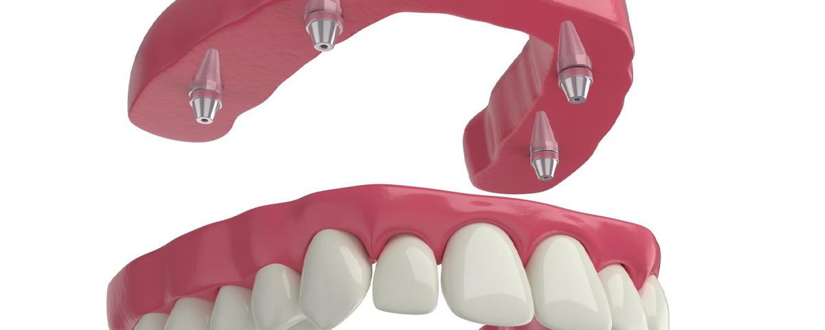 About Phoenix All-on-4 Dental Implants