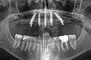 All on 4 Denture Procedure and Costs