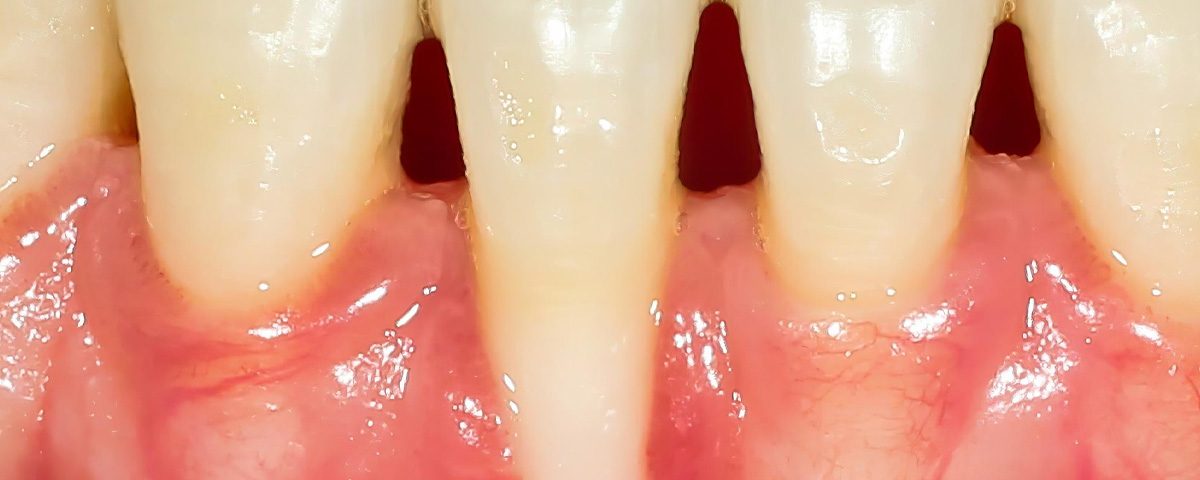 Before and After Pinhole Gum Rejuvenation in Phoenix