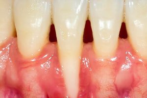 Before and After Pinhole Gum Rejuvenation in Phoenix