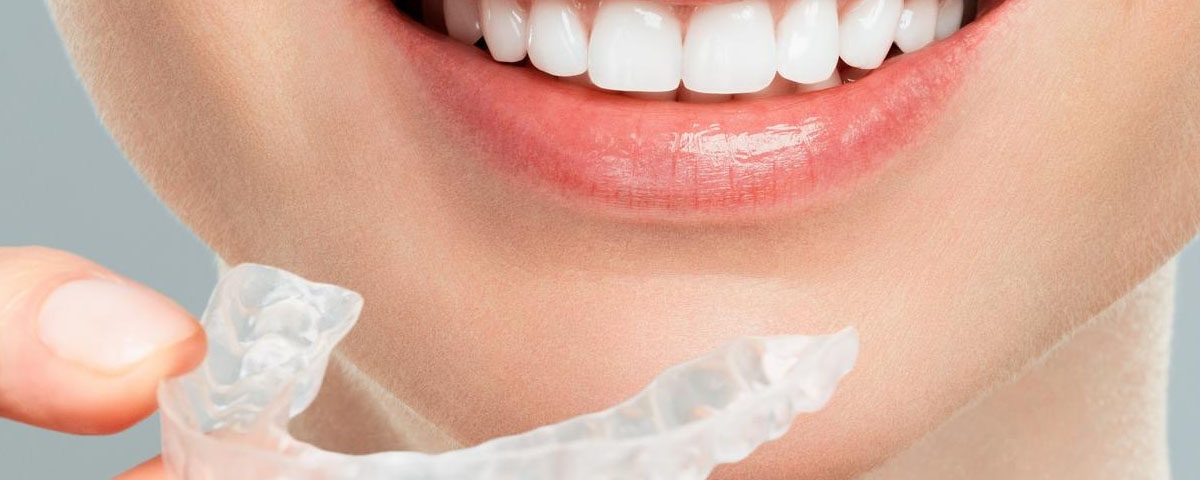 Do You Need a Vivera Retainer After Invisalign