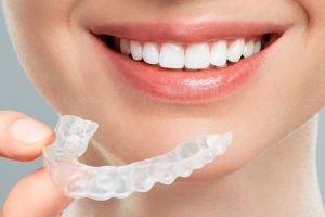 Do You Need a Vivera Retainer After Invisalign