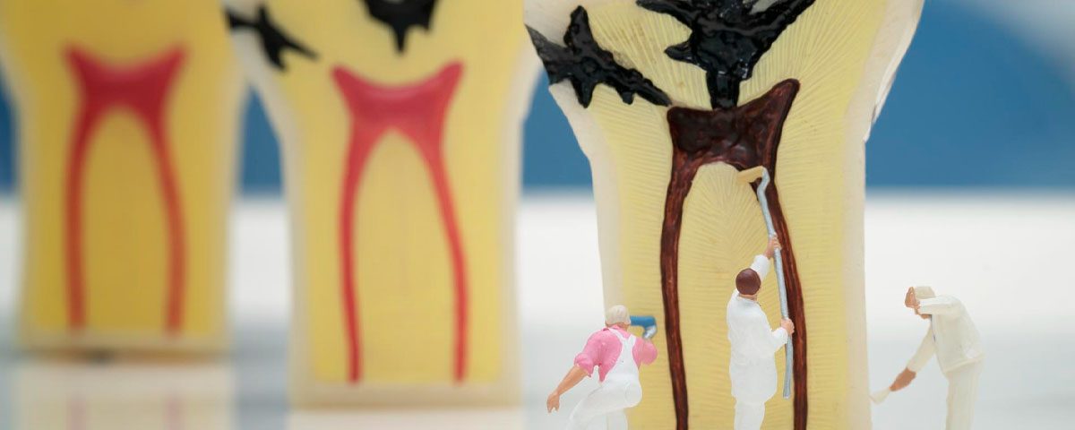 How Dental Cavities Are Classified