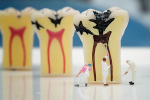 How Dental Cavities Are Classified