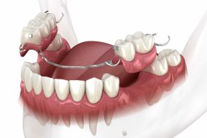 What Is A Flipper and Why Do You Need One