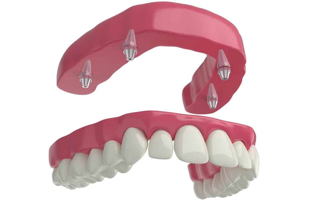 Advantages of All-on-X Implants