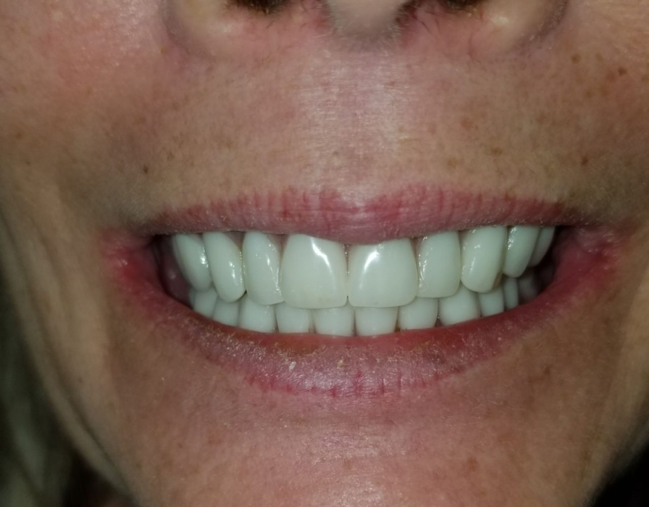 Phoenix All On 4 Dental Implants Central Valley Dentistry