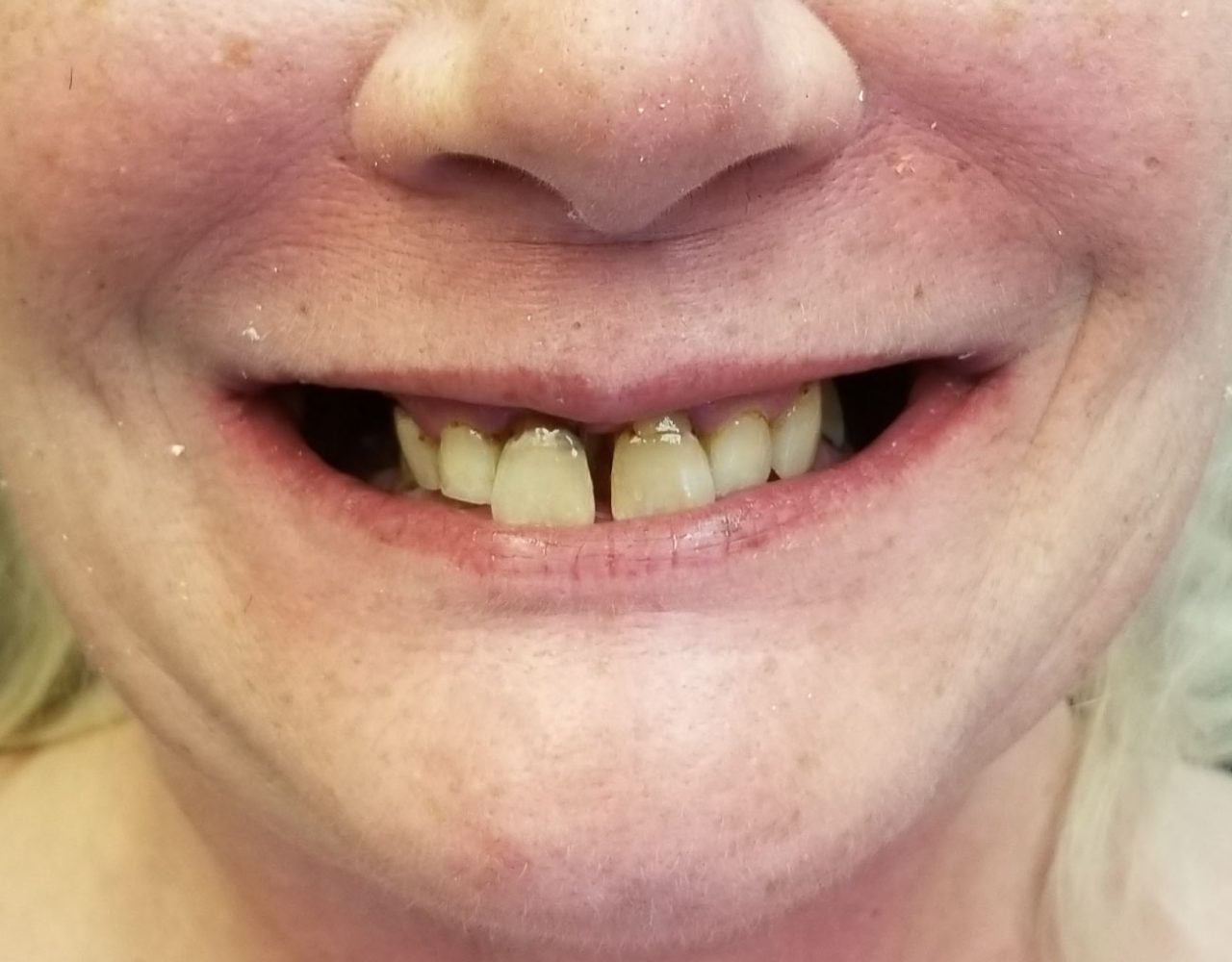 Phoenix All On 4 Dental Implants Central Valley Dentistry