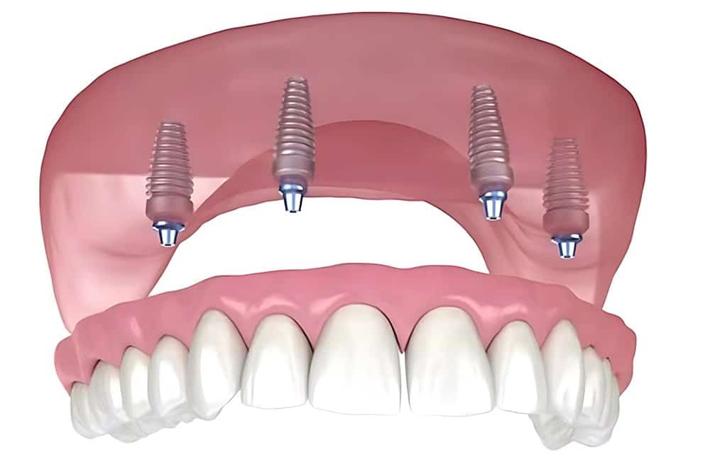 All-on-X Dental Implants Definition