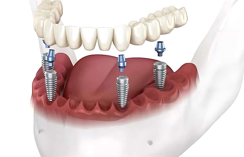 All-on-X vs. Dentures