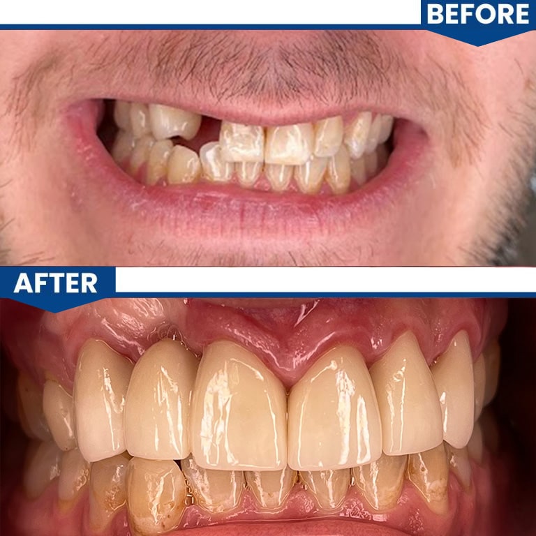 Emergency Dentistry - Before After