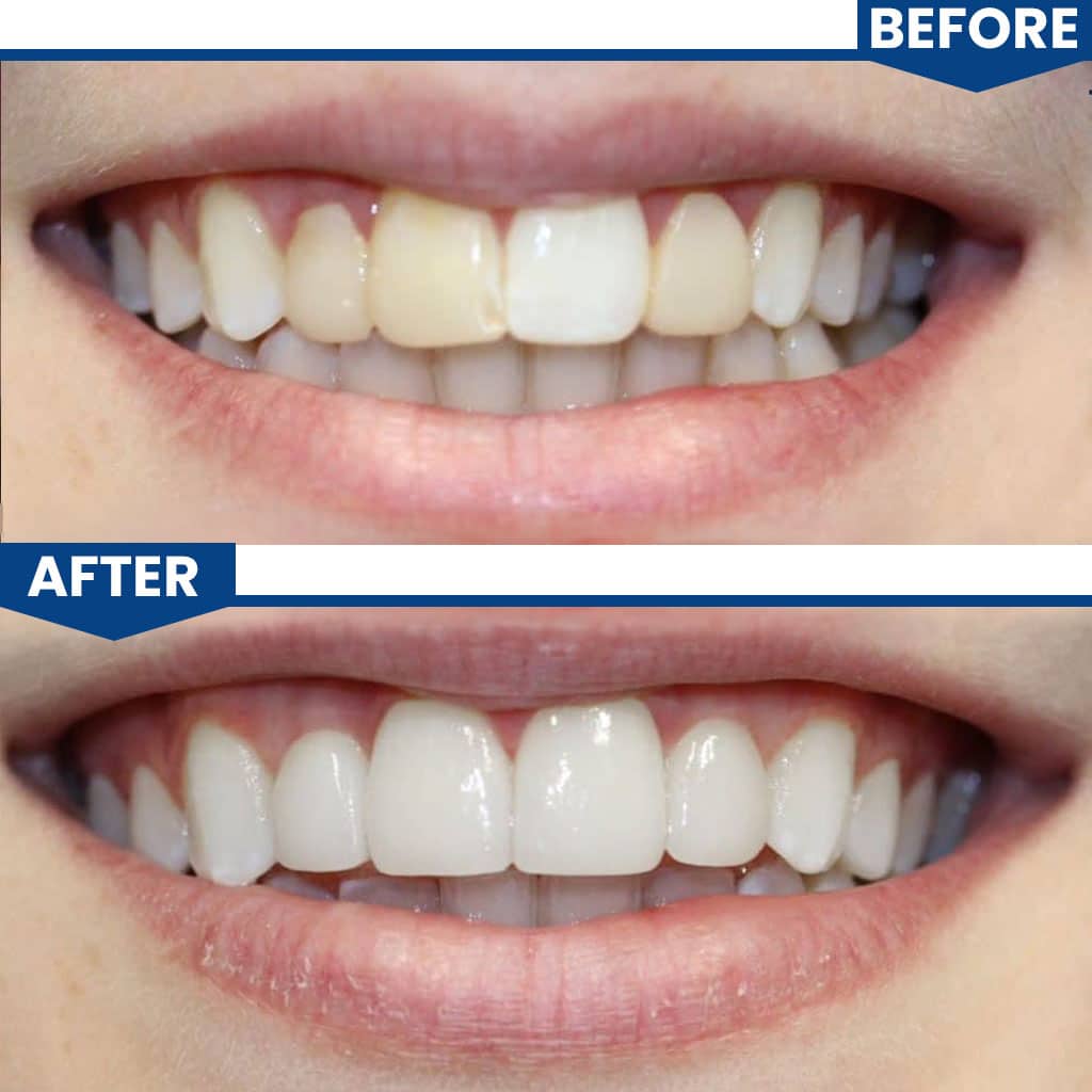 Full Arch - Before After