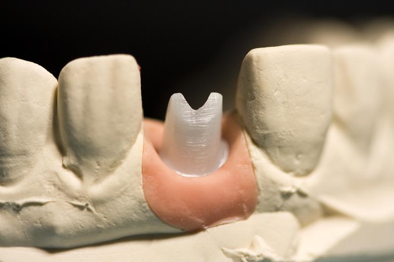 Phoenix Dental Implant Restoration