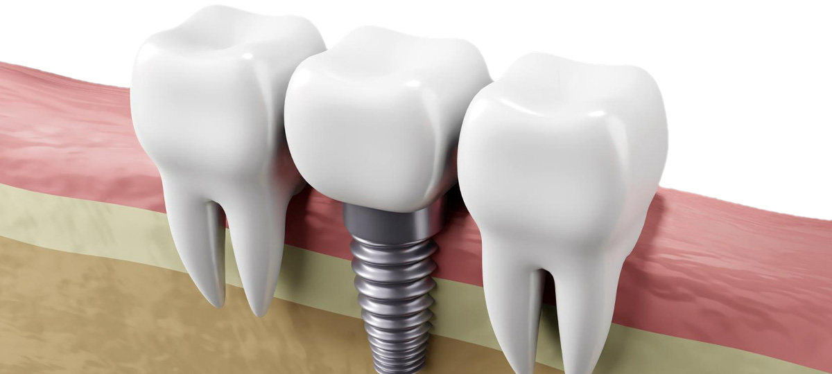 Same-Day Implant on an Infected or Broken Non-Savable Tooth