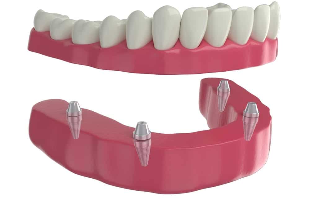 Why Choose Dental Implants