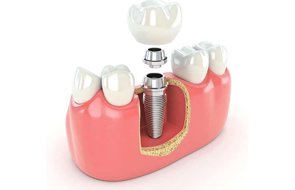 Why Choose Dental Implants