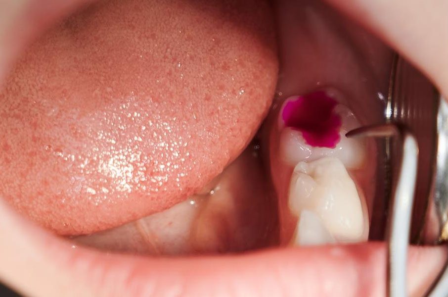 Dental Fillings in Phoenix