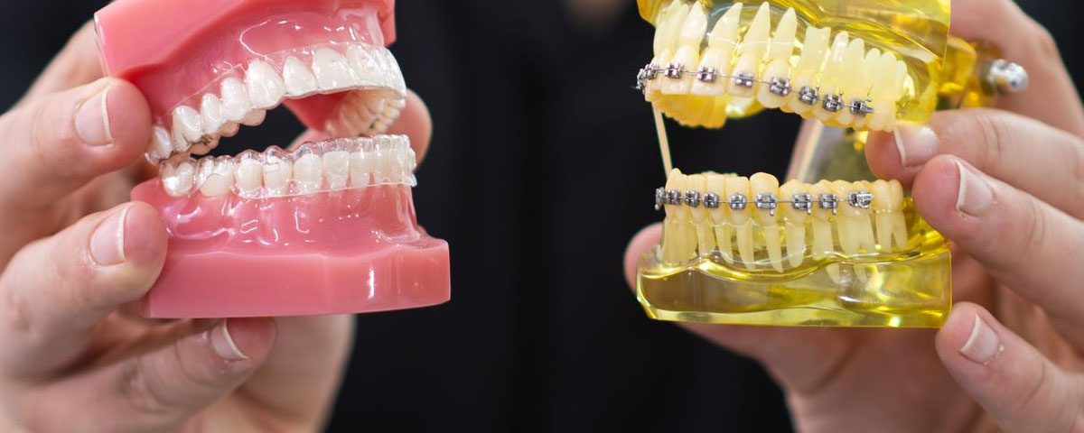 Does Invisalign Hurt More Than Braces