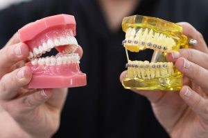 Does Invisalign Hurt More Than Braces