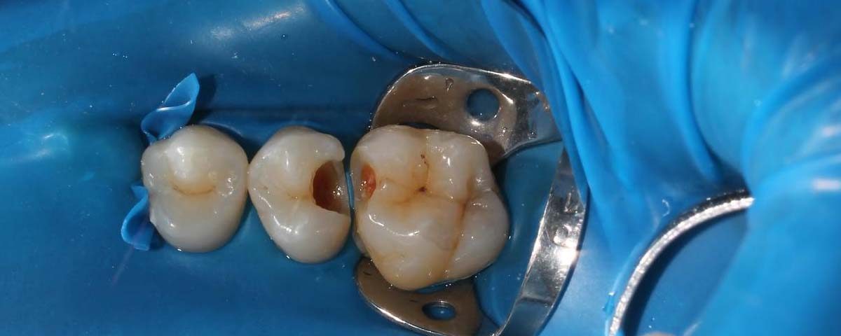 Why Has My Tooth Filling Cracked