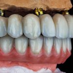 How Long Do All-on-4 Implants Last