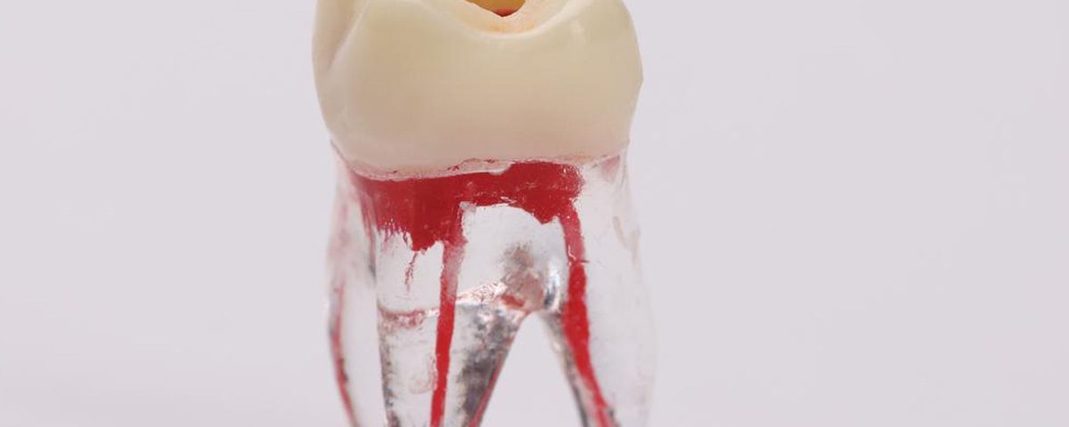 Pulpotomy vs. Root Canal Therapy Which is Best