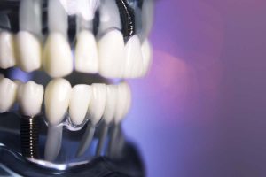 How Long Does a Tooth Implant Take to Heal