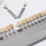 Dental Bonding vs. Veneers What Are the Differences?