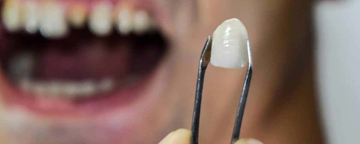 Dental Crown vs Filling What Are the Differences?