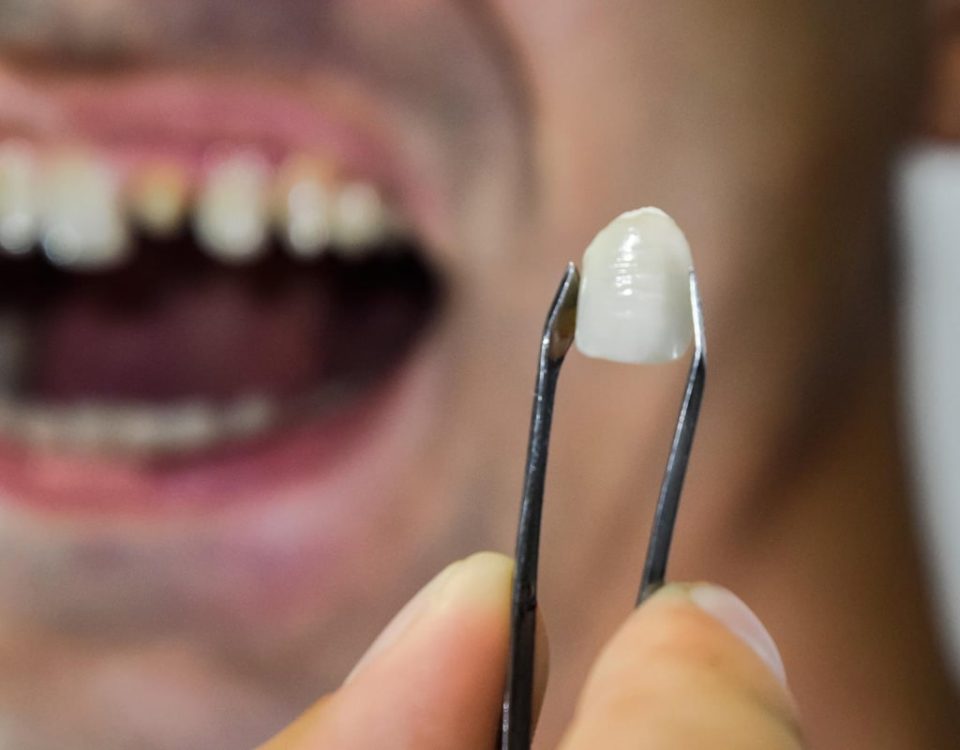 Dental Crown vs Filling What Are the Differences?