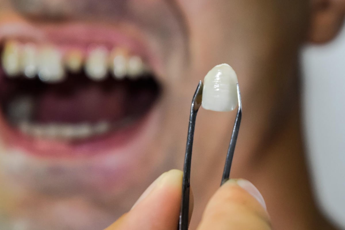 Dental Crown vs Filling What Are the Differences?