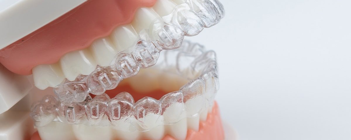 Can Invisalign Cause Root Resorption?