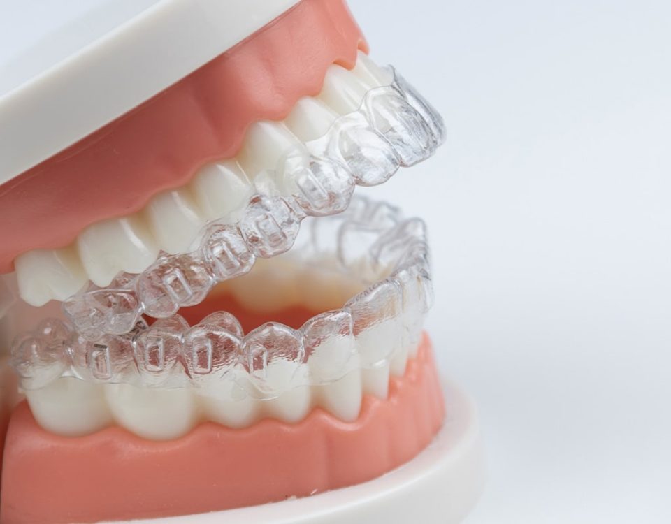 Can Invisalign Cause Root Resorption?