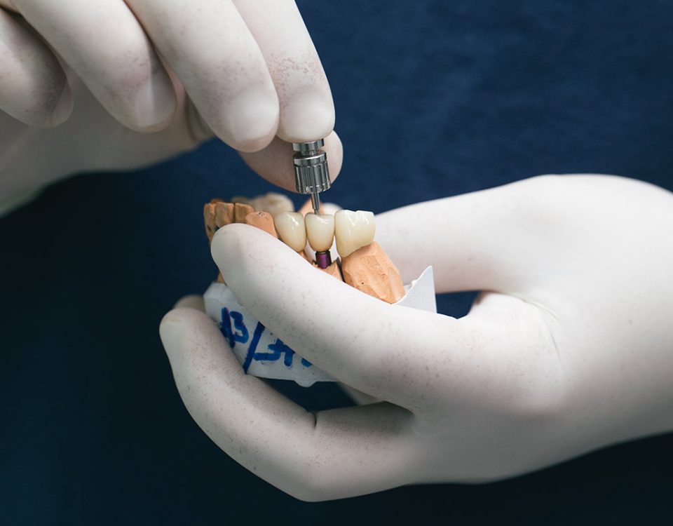 5 Steps of Dental Implant Restoration
