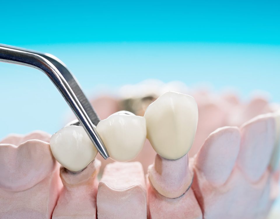 Can a Dental Bridge Be Removed and Re-cemented?