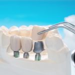 What Are Healing Caps in Dental Implants?