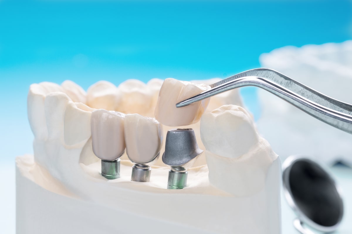 What Are Healing Caps in Dental Implants?