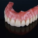 5 Differences Between Snap-on Dentures and All-on-4