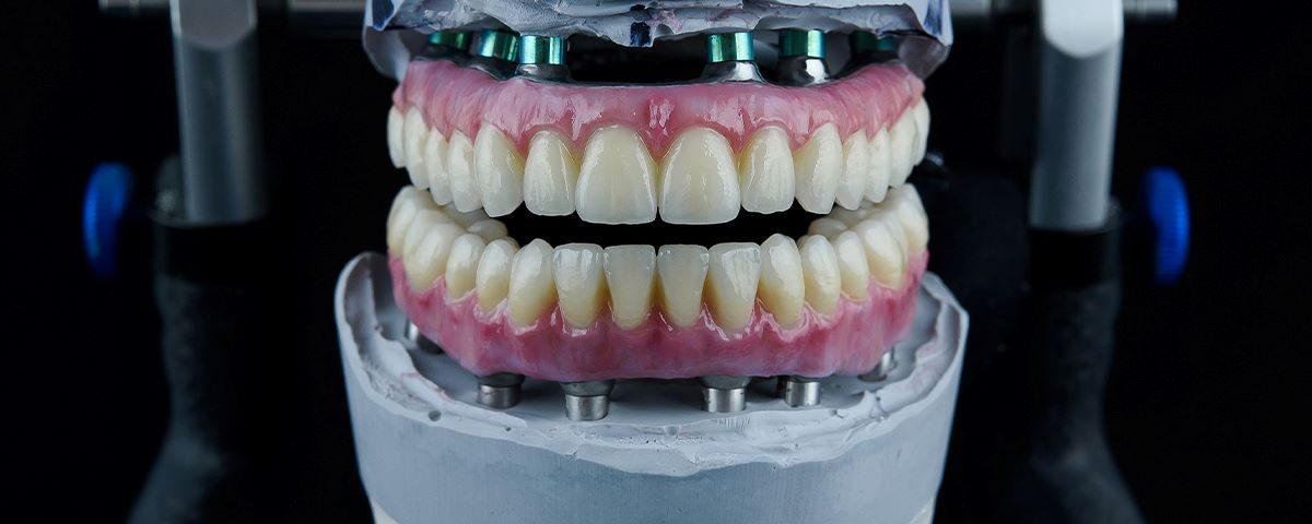 What Are the Differences Between All-on-4 and Overdenture?