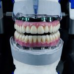 What Are the Differences Between All-on-4 and Overdenture?