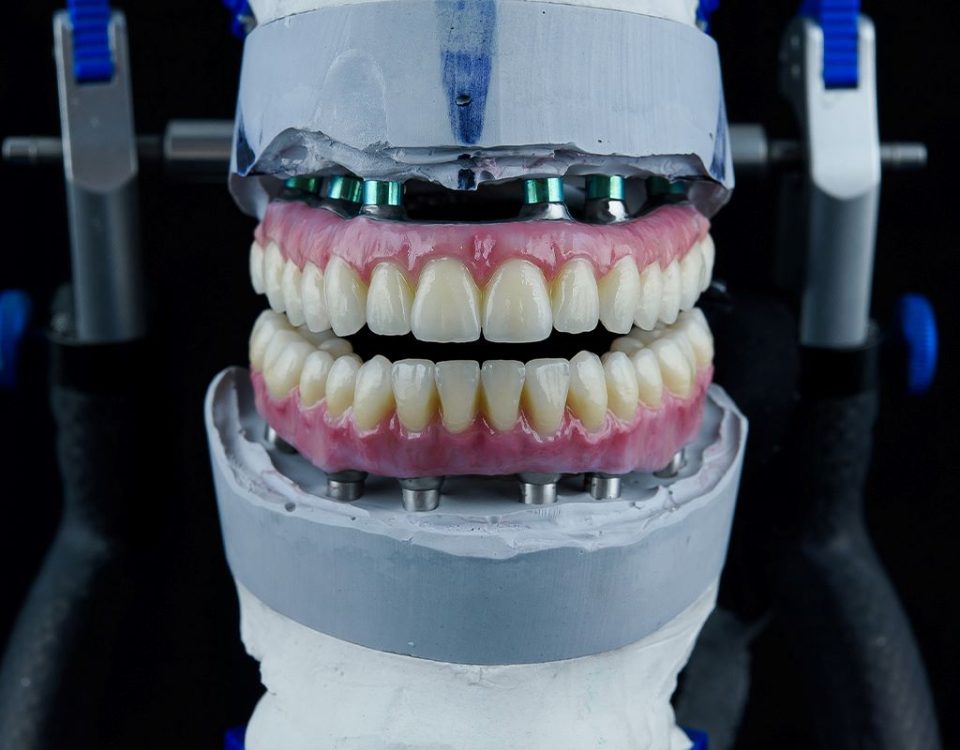 What Are the Differences Between All-on-4 and Overdenture?