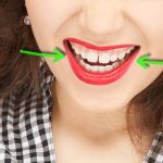 4 Ways To Fix Gaps Between Teeth