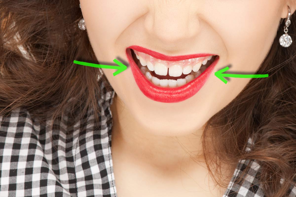 4 Ways To Fix Gaps Between Teeth