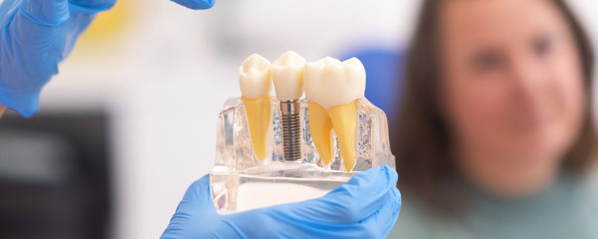 5 Differences Between One-Day Dental Implants and Traditional Implants