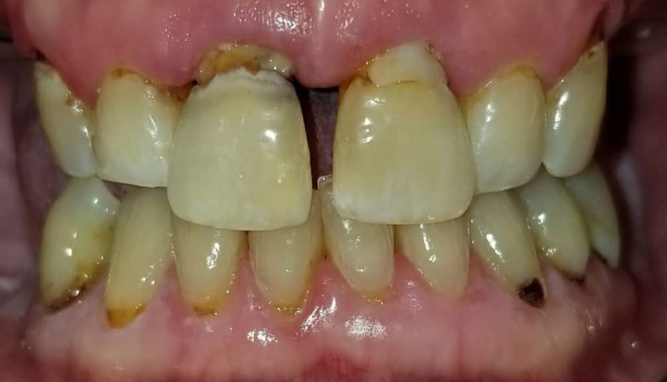 Before and After Dental Implants in Chandler, AZ