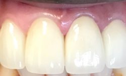Before and After Dental Implants in Chandler, AZ