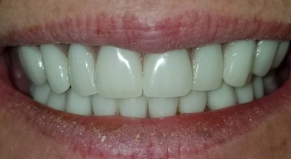 Before and After Dental Implants in Mesa, AZ