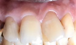 Before and After Dental Implants in Mesa, AZ