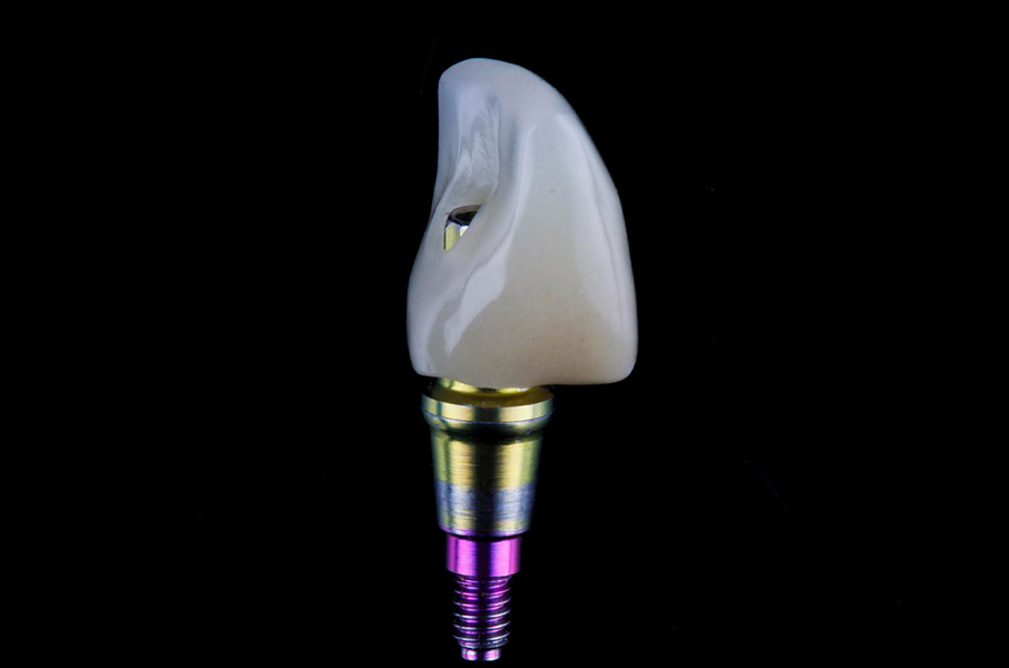 Dental Implants in Chandler, AZ