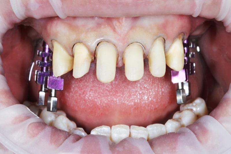 Multiple Tooth Implants Phoenix